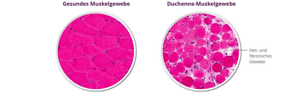 Duchenne-Gewebe