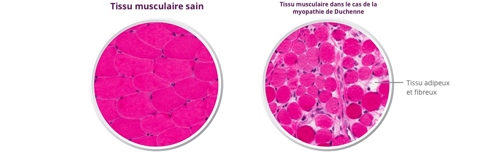 Tissu de la maladie de Duchenne