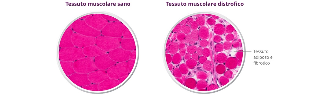 Tessuto di Duchenne